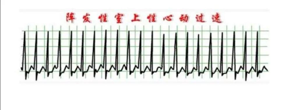 心脏电生理检查多少钱1份30元的心电图