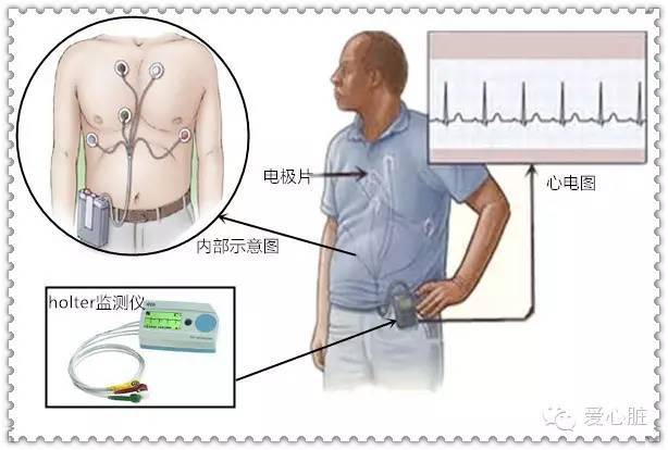 跟我们平时体检医生给做的心电图可不一样,当你背着holte时,它会记录