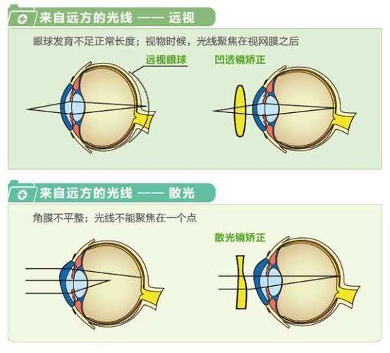 北京哪家医院治疗远视加散光?