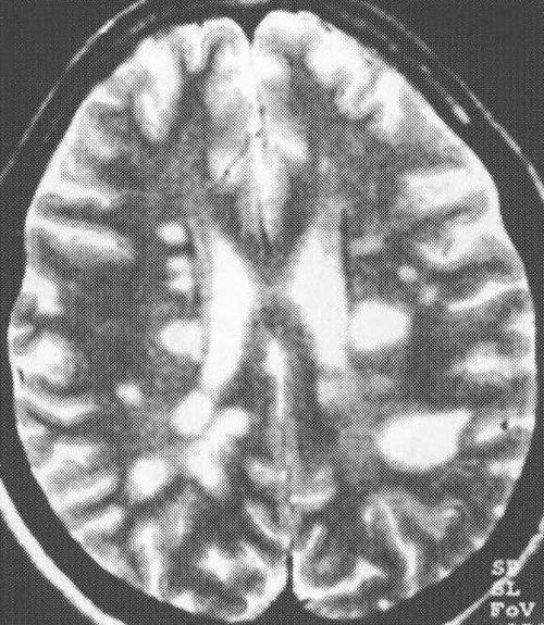 例3多发性硬化