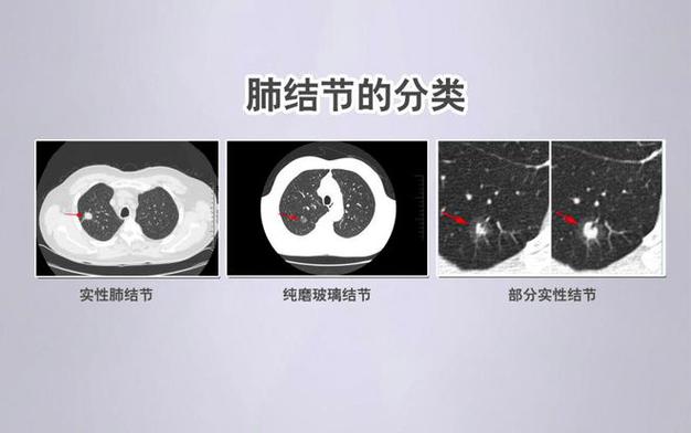 肺结节多久会变成肺癌?