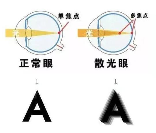 近视手术可以矫正多少度的散光?|屈光|度数_网易订阅