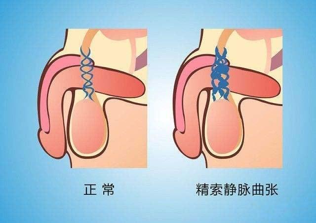 精索静脉曲张症状表现示意图