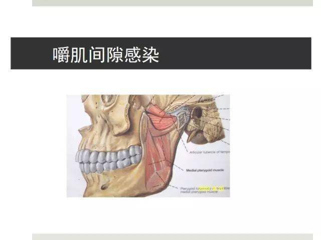 口腔颌面部间隙感染多图