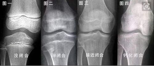 如果发现孩子过矮,一定要在骨骼闭合前干预.