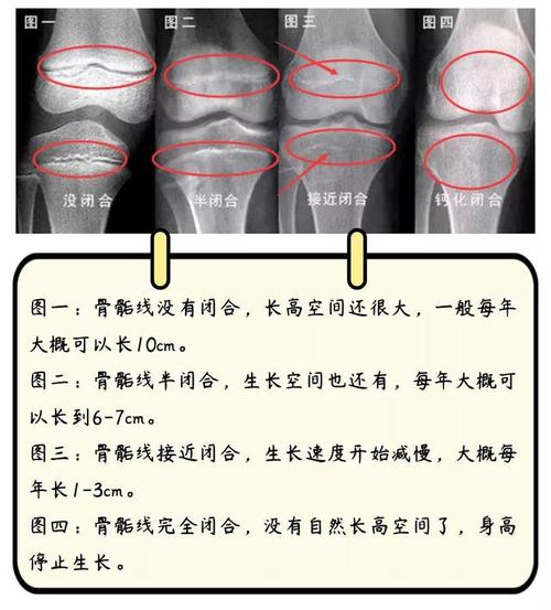 是骨骺线闭合 骨骺线是指长骨干骺端与骨骺之间的一层软骨,用于长高