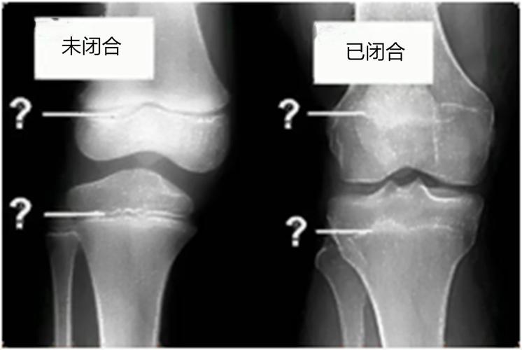 三种信号提示孩子骨骼线即将闭合父母及时发现及时补救很重要