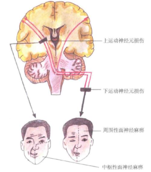 几幅图带你认识面神经,了解面瘫, 懂得治疗