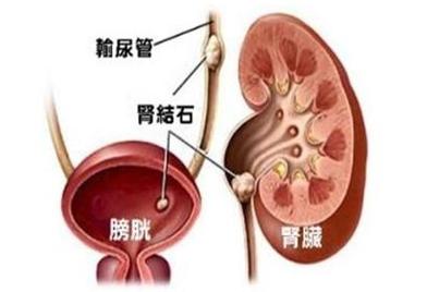 长了肾结石,多喝水就能排掉吗?_液体_患者_饮水量