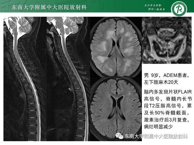 多发性硬化 影像表现