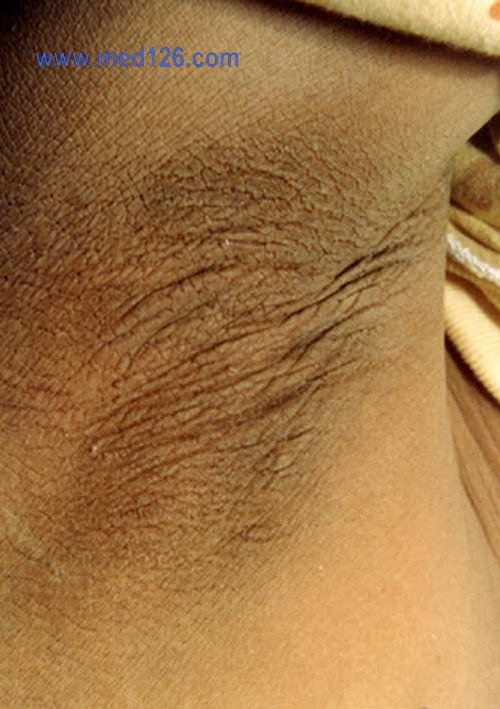 黑棘皮症(acanthosis nigricans)06