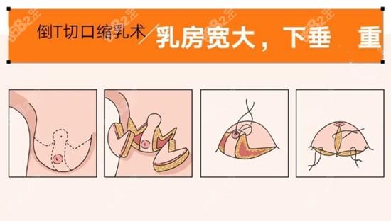 乳房棒棒糖悬吊术