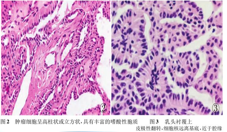 病理交流|乳腺免疫组化的应用