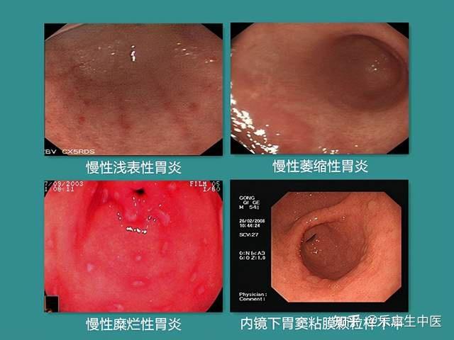 腹胀腹痛胃灼热中医1个方子调养脾胃改善慢性萎缩性胃炎