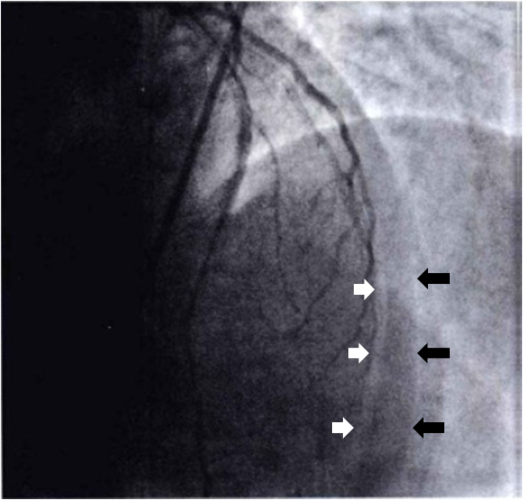 【中山pci解码·第12篇】冠脉穿孔必杀技系列5:急性心包填塞的心包