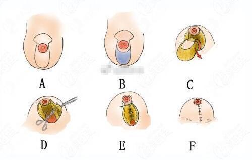 做过乳房提升手术后,回答乳房下垂人工韧带乳房提升术和悬吊术区别