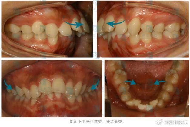 儿童健康守护者计划##健闻登顶计划##腺样体肥大##腺样体面容