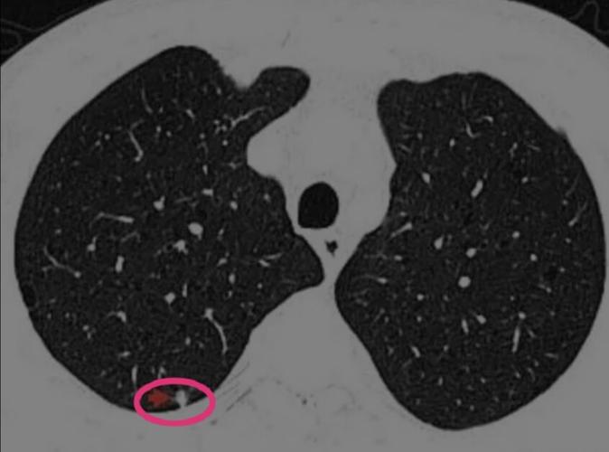 肺部5mm微小实性结节,有可能是恶性程度最高的肺癌_肺癌_症状表现