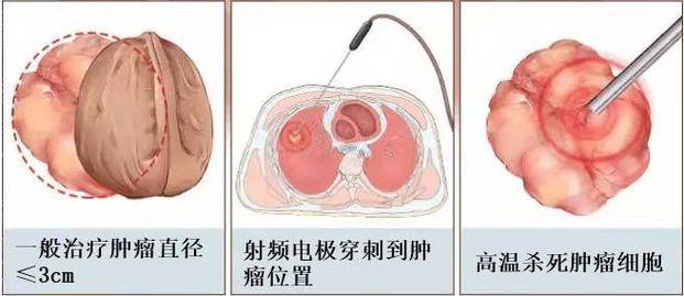 【技术分享】晋江二院开展ct引导下肺结节射频消融术_治疗_定位_患者