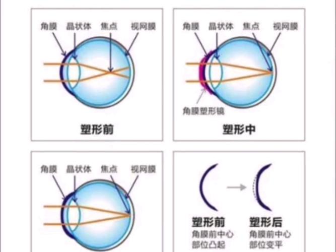 【sub纱布】7815角膜塑形镜/视力矫正/近视散光矫正