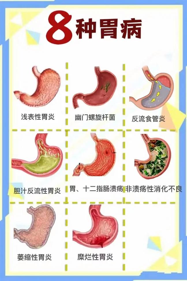 8种胃病,看看你中招了吗?#萎缩性胃炎 #慢性胃炎 #健康科 - 抖音