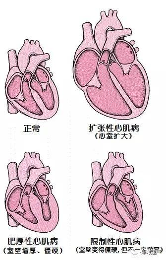 带你了解常见心肌病的心电图表现