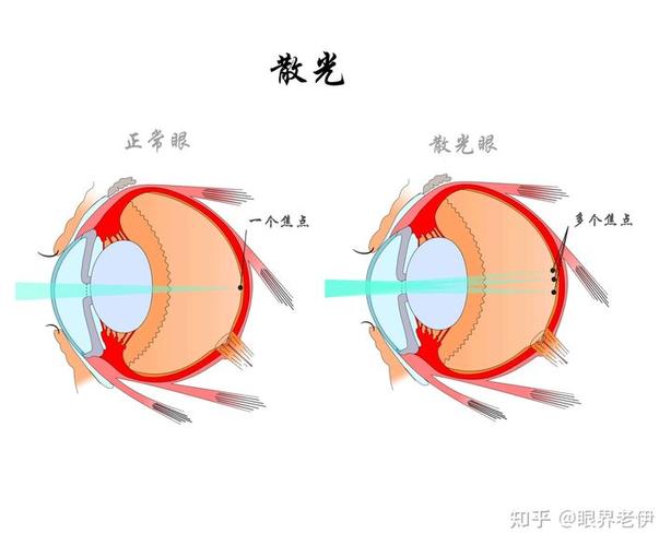 那么是不是近视手术能矫正所有的散光呢? 也不是!