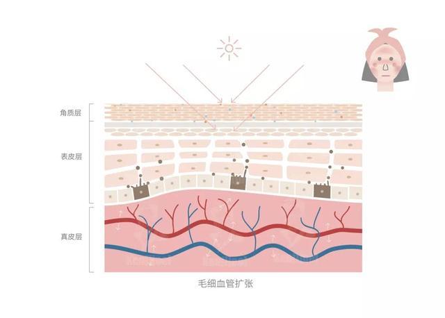 毛细血管扩张