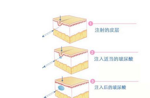 玻尿酸注射图解