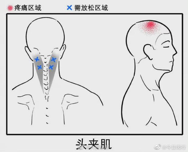 3个动作缓解多种头痛##不同位置头痛的按摩方法