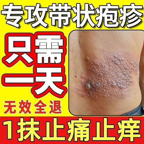 带状疱疹后遗症神经痛外用膏特效中药蛇缠腰蛇盘疮止痛止痒断根