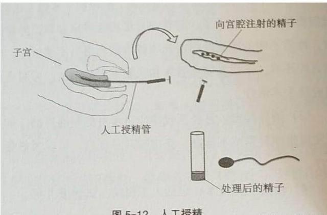 有些女性方面造成的不孕也能采用人工授精,如阴道痉挛,宫颈细小,宫颈