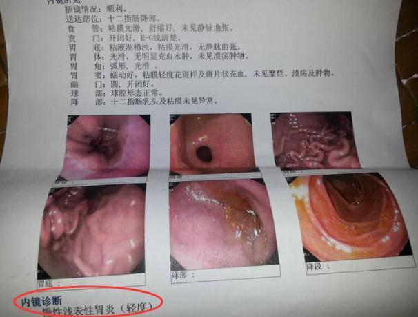 原创慢性胃炎合并胃溃疡病理分析!