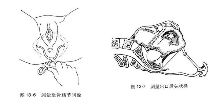 骨盆外测量