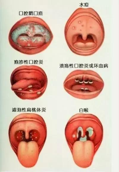 宝宝鹅口疮,可别不当回事_手机搜狐网