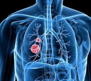 肺部有个结节应该不拘小节吗